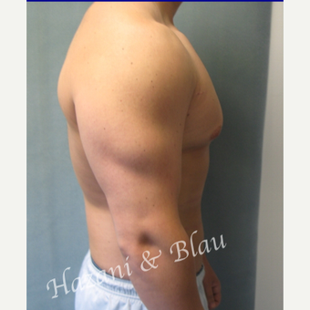 18-24 year old man treated with Male Breast Reduction before 3332944
