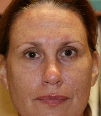 Botox before 673335