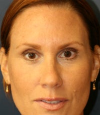 Botox after 673335