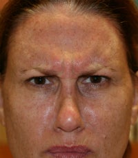 Botox 673335