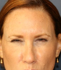 Botox 673335