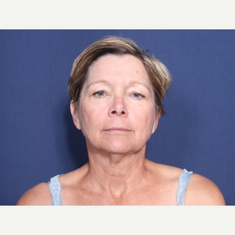 55-64 year old woman treated with Neck Lift (view 1 of 2) before 3175421