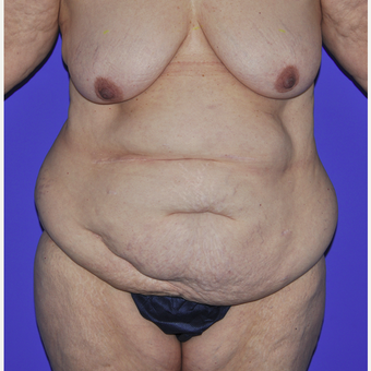 55-64 year old woman treated with Body Lift before 3455249