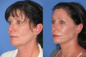 Laser Skin Resurfacing before 1156584