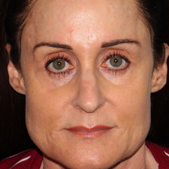 54 year old woman treated with Botox for clenching, teeth grinding, headaches,and enlarged masseters before 3623954