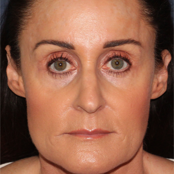 54 year old woman treated with Botox for clenching, teeth grinding, headaches,and enlarged masseters after 3623954