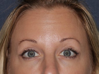 Before & After Botox after 931511