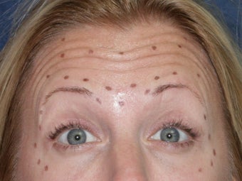 Before & After Botox before 931511
