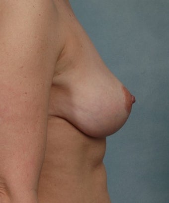 Breast Lift 1267006