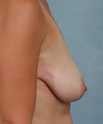 Breast Lift 1267006
