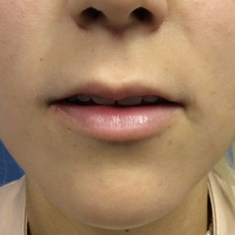 18-24 year old woman treated with Juvederm Ultra plus before 3727283