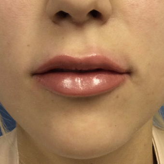 18-24 year old woman treated with Juvederm Ultra plus after 3727283