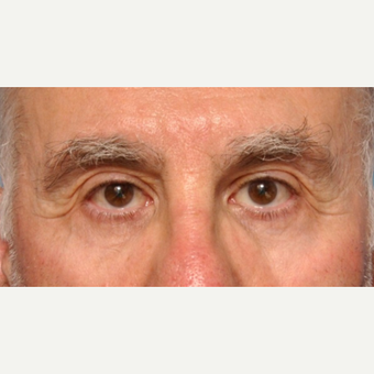 Lower Eyelid Surgery with Fat Pad Removal and Laser Resurfacing after 3691684