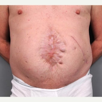 Surgical Scar Revision before 1698046