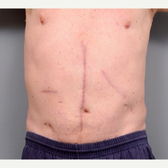 Surgical Scar Revision after 1698046