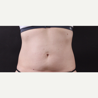 49 year old woman treated with CoolSculpting before 3630234
