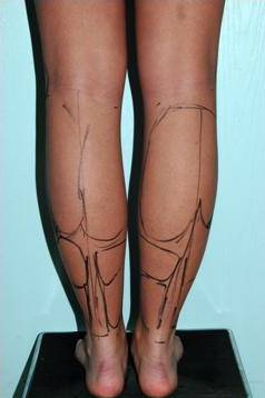 Calve and Ankle Liposculpture 1277263