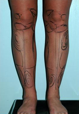 Calve and Ankle Liposculpture before 1277263