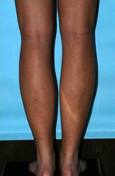 Calve and Ankle Liposculpture 1277263