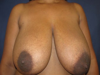 Breast Reduction before 291340