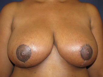 Breast Reduction after 291340