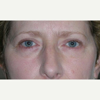 45-54 year old woman treated with Eye Bags Treatment after 1905687