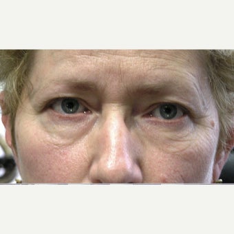 45-54 year old woman treated with Eye Bags Treatment before 1905687