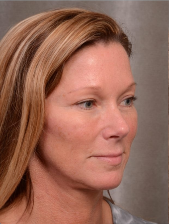 48 Years Old Facial Rejuvenation with Juvederm Voluma before 1498243