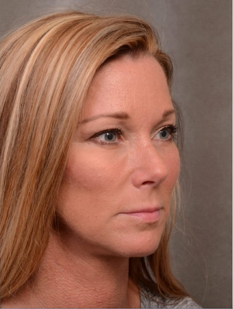 48 Years Old Facial Rejuvenation with Juvederm Voluma after 1498243