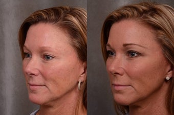 48 Years Old Facial Rejuvenation with Juvederm Voluma 1498243
