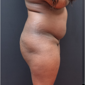 25-34 year old woman treated with Butt Augmentation before 3363840