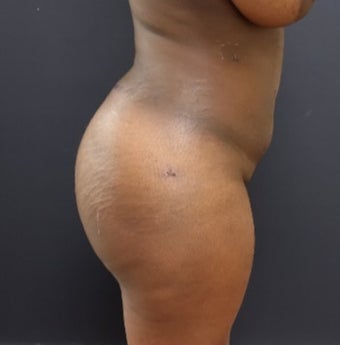 25-34 year old woman treated with Butt Augmentation after 3363840