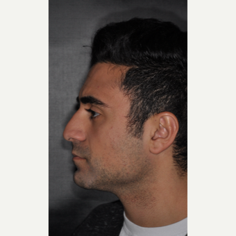 18-24 year old man treated with Nose Surgery 6 weeks post-op before 3500210
