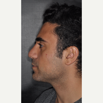 18-24 year old man treated with Nose Surgery 6 weeks post-op after 3500210
