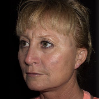 45-54 year old woman treated with Liquid Facelift after 1806313