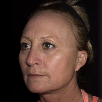 45-54 year old woman treated with Liquid Facelift before 1806313