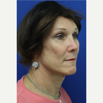 45-54 year old woman treated with Facial Feminization Surgery after 3741525