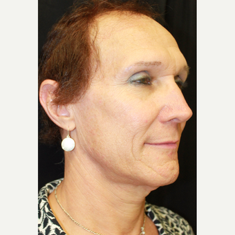 45-54 year old woman treated with Facial Feminization Surgery before 3741525