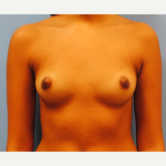 20 year old woman treated with Breast Implants. Saline, 290 cc filled to 300 cc. A to C cup. before 3304503