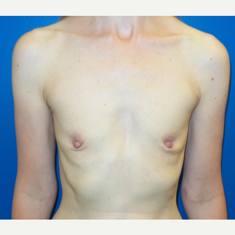 25-34 year old woman treated with Breast Augmentation before 3777538