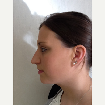 25-34 year old woman treated with Rhinoplasty before 3122784