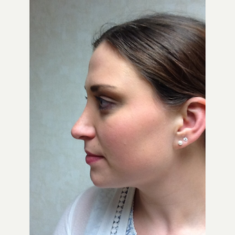 25-34 year old woman treated with Rhinoplasty after 3122784