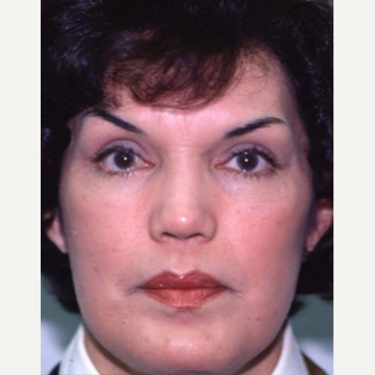55-64 year old woman treated with Eyelid Surgery after 3094018