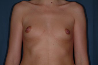 Breast Augmentation before 336298