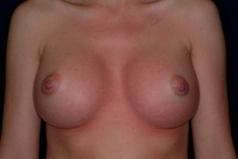 Breast Augmentation after 336298