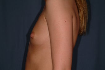 Breast Augmentation 336298