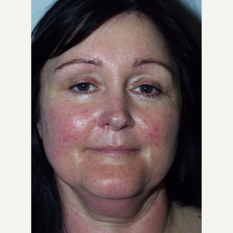 48 year old woman undergoes lower facelift before 3440025