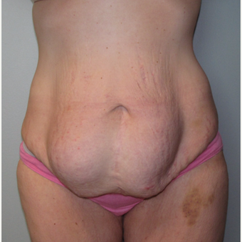 25-34 year old woman treated with Panniculectomy & Hernia Repair before 3141345