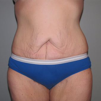 25-34 year old woman treated with Panniculectomy & Hernia Repair after 3141345