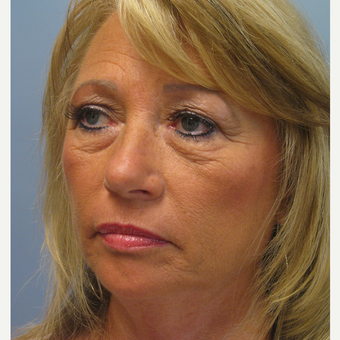 55-64 year old woman treated with Brow Lift before 3538877